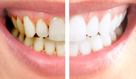 Korst Naar behoren Kameraad Tanden Bleken Hoofddorp: Veilig mooie witte tanden | Tandartspraktijk  Overbos