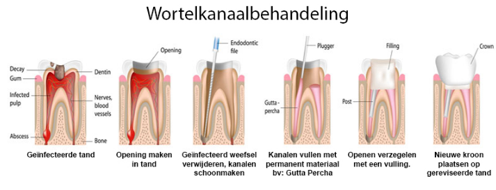Wortelkanaalbehandeling | Tandartspraktijk Overbos